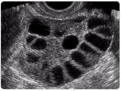 Polikistik Over Sendromu Tedavisi